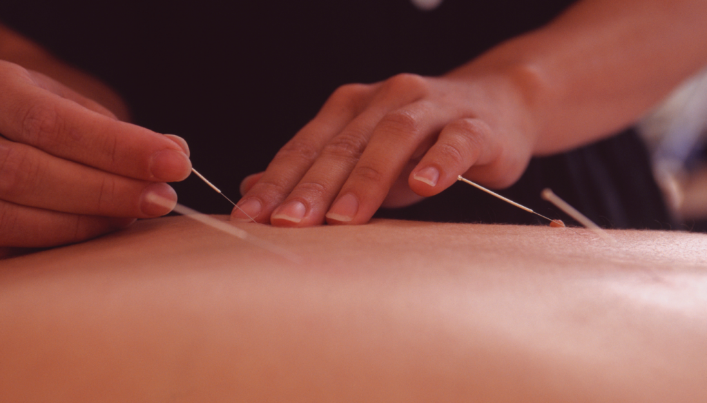 "Persona recibiendo una sesión de acupuntura médica en zaragoza con agujas colocadas en puntos específicos del cuerpo para promover el equilibrio y el bienestar."